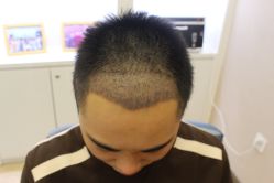 -大麦微针植发丨全国连锁