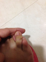 iphone_upload_pic-EPAI·灰指甲·甲沟炎·嵌甲护理