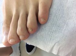 -德哥灰指甲脚气甲沟炎跖疣护理
