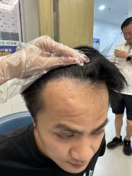 -大麦微针植发全国连锁