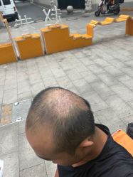-大麦微针植发丨全国连锁
