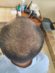 -碧莲盛·不剃发植发