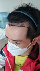 -大麦微针植发丨全国连锁