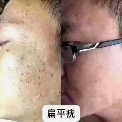 -瑶芳清颜草本祛痘
