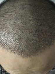 点击看大图 -大麦微针植发丨全国连锁