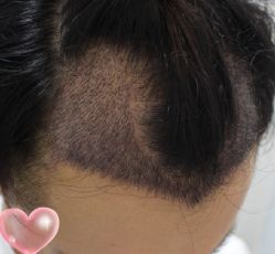 -大麦微针植发丨全国连锁