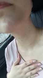 体验后-颜蕾医美黄金微针水光美肤玻尿酸抗衰中心