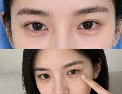 -天津健丽·去眼袋医疗美容机构