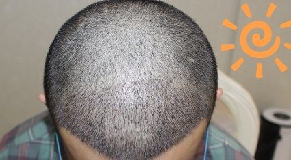 -大麦微针植发丨全国连锁