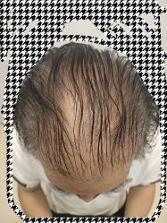 体验前-大麦微针植发丨全国连锁