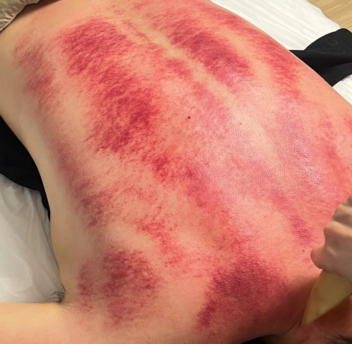 今天你刮痧了吗