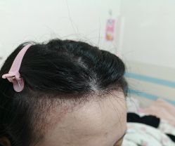 -碧莲盛·脱发养发中心