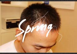 点击看大图 体验后-大麦微针植发全国连锁