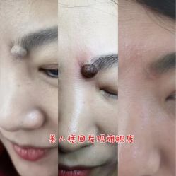 -美人痣全国连锁