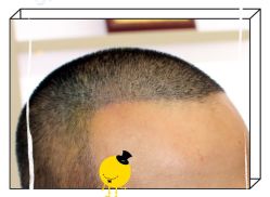 -大麦微针植发全国连锁