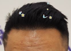 -大麦微针植发全国连锁