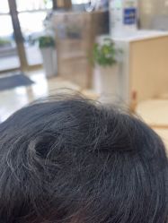 -碧莲盛·不剃发植发
