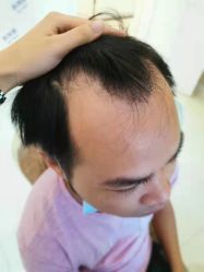 点击看大图 体验前-大麦微针植发全国连锁