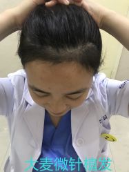 点击看大图 -大麦微针植发丨全国连锁