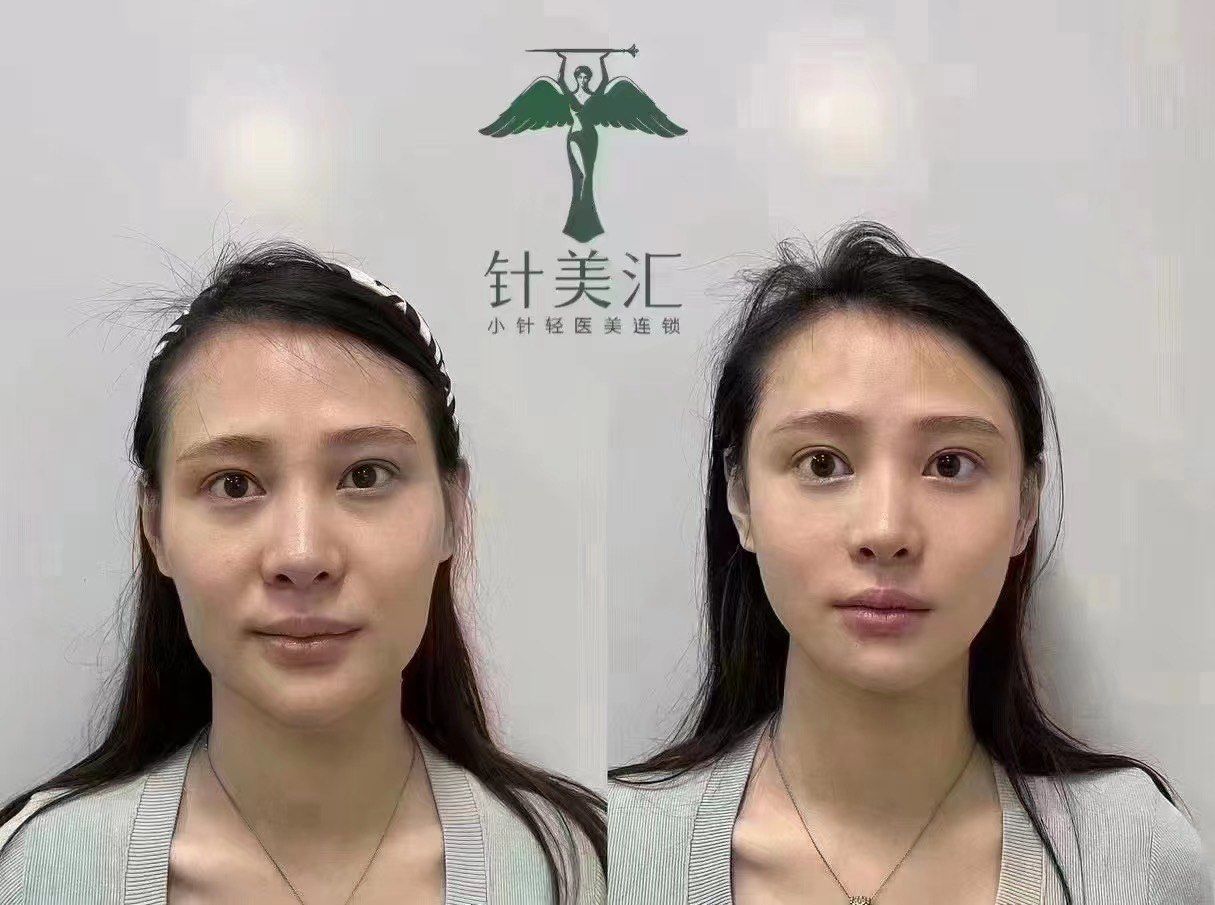 61针美汇26年专注一根针的技术
让