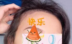 -大麦微针植发全国连锁