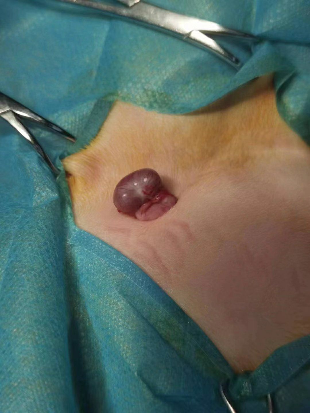 可乐小朋友,双侧皮下隐睾,从此解决终身大