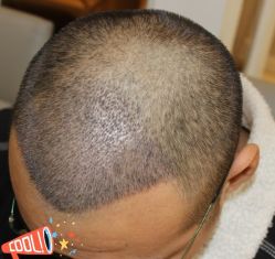 -大麦微针植发丨全国连锁