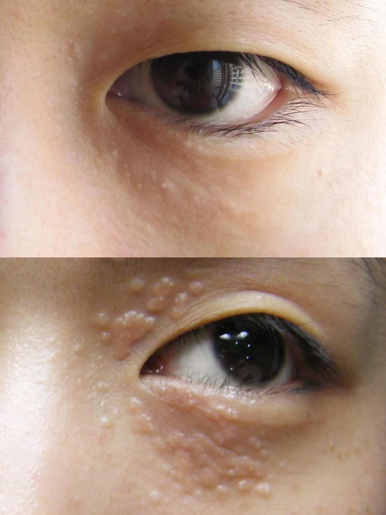 汗管瘤也叫眼部结石
医学名汗腺末端错