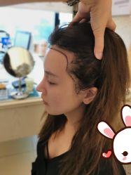 点击看大图 -大麦微针植发丨全国连锁