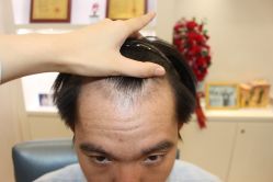 -大麦微针植发丨全国连锁