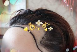 -大麦微针植发全国连锁