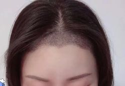 -大麦微针植发全国连锁