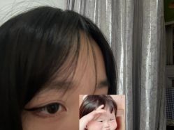 体验后-大麦微针植发全国连锁