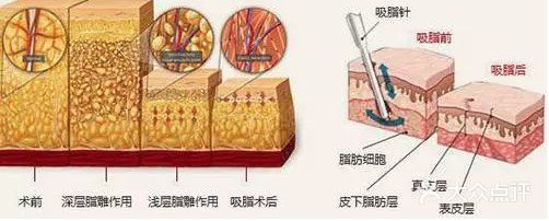 吸脂前一定要注意这些问题