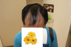 -大麦微针植发丨全国连锁