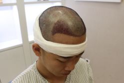 -大麦微针植发丨全国连锁