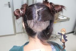 -大麦微针植发丨全国连锁