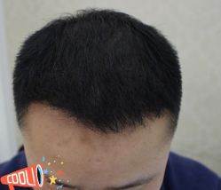 -大麦微针植发丨全国连锁