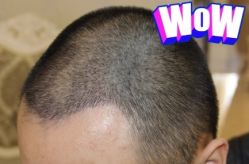 -大麦微针植发丨全国连锁