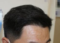 -大麦微针植发全国连锁