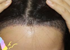 -大麦微针植发丨全国连锁