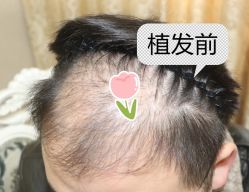 -大麦微针植发全国连锁