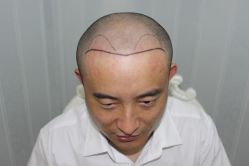 -大麦微针植发丨全国连锁