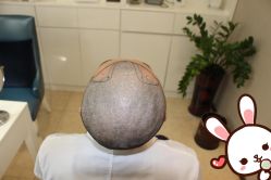 -大麦微针植发丨全国连锁