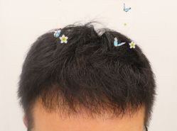 -大麦微针植发全国连锁