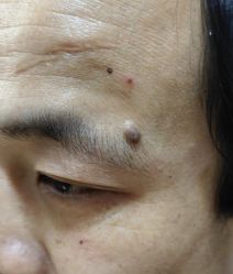 体验前-北京美痣堂古方祛痣斑疣瘊