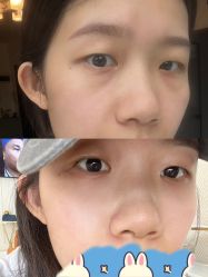 -广州健丽·去眼袋医疗美容机构