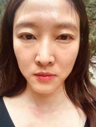 -美丽人生祛斑扁平疣汗管瘤中心