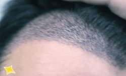 -大麦微针植发丨全国连锁