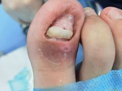 -Andrew指甲专科灰指甲·甲沟炎矫正·3D步态矫形鞋垫定制(浦三路店)